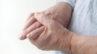dietary features for arthritis